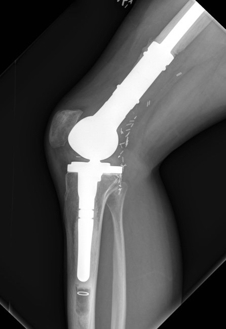 Ewings femur resection 2