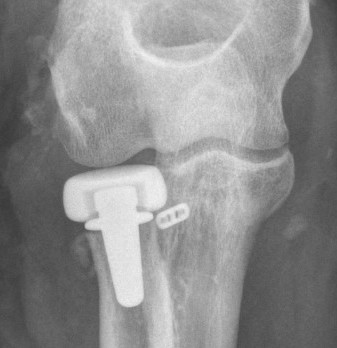Ulnohumeral joint space