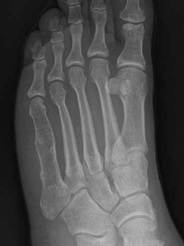 Enchondroma foot 