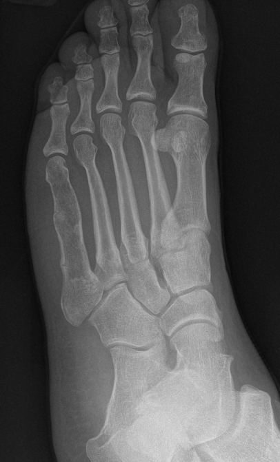 Enchondroma foot 1