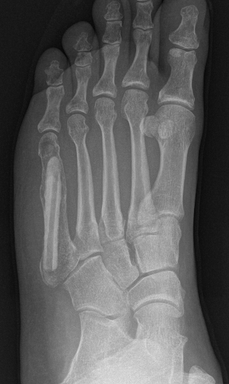 Enchondroma foot 2