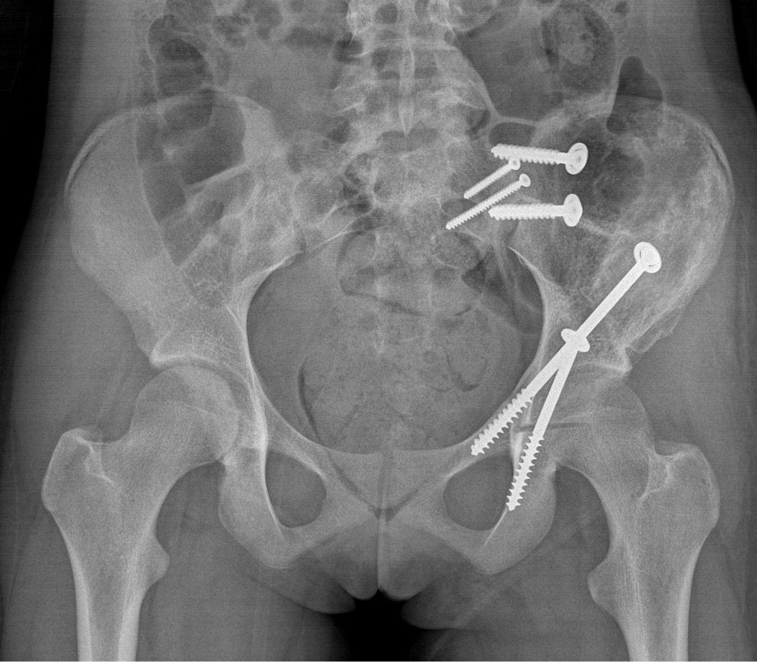 Ewings pelvis surgical resection