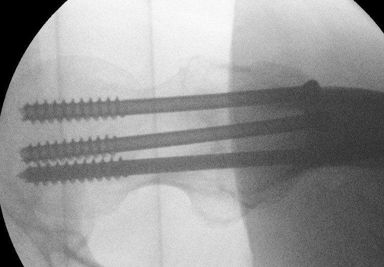 Hip cann screws 2