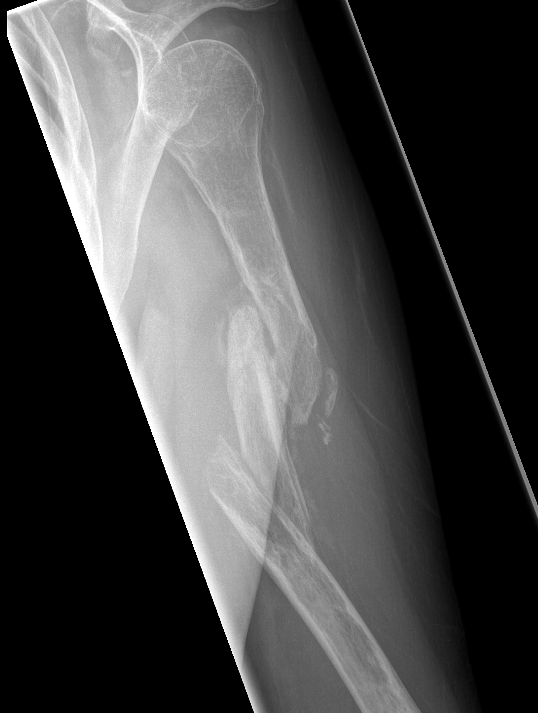 Humerus nonunion