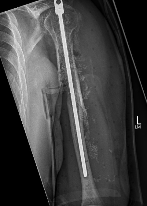 Humerus infected 2