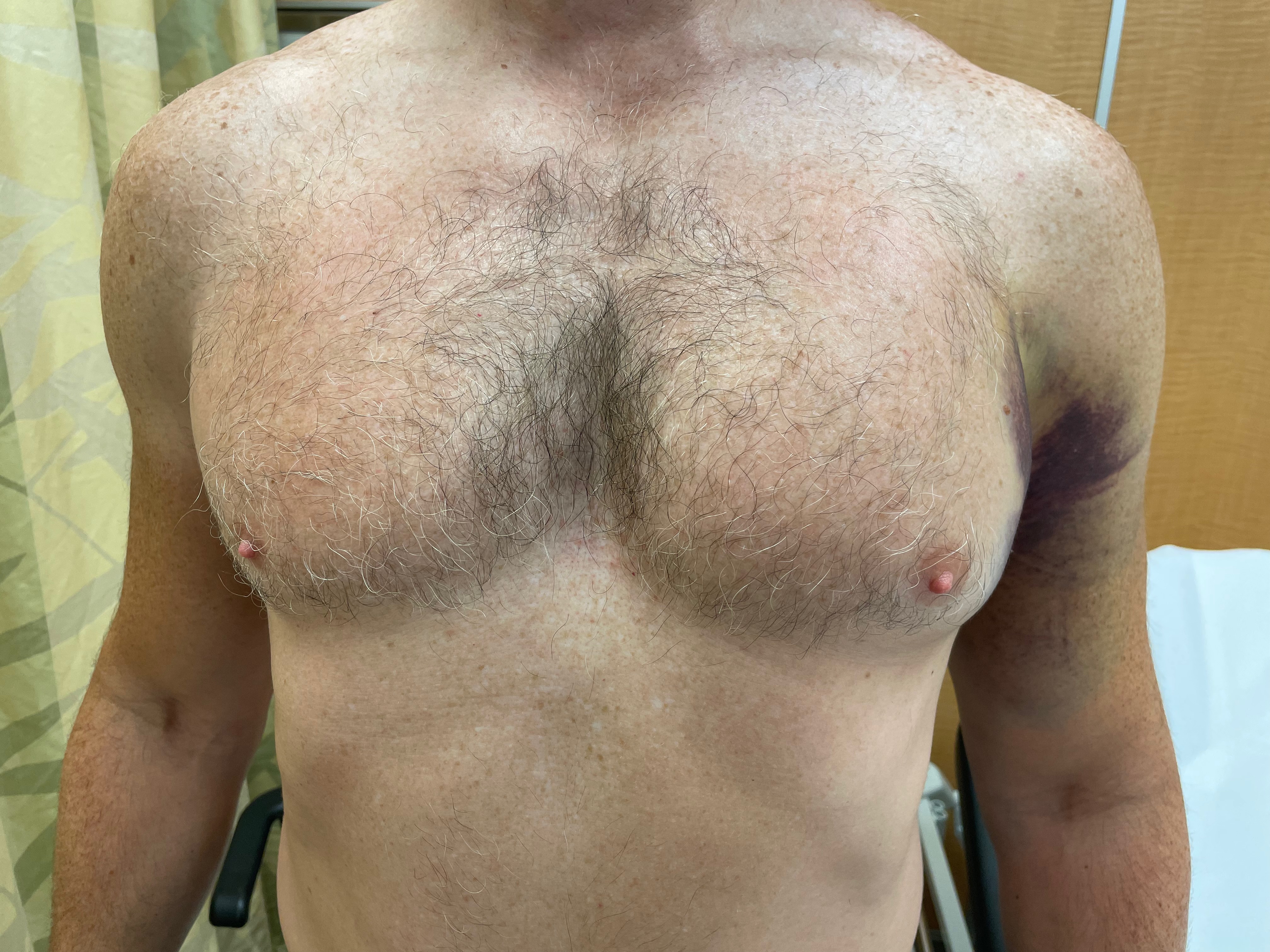 pec tear