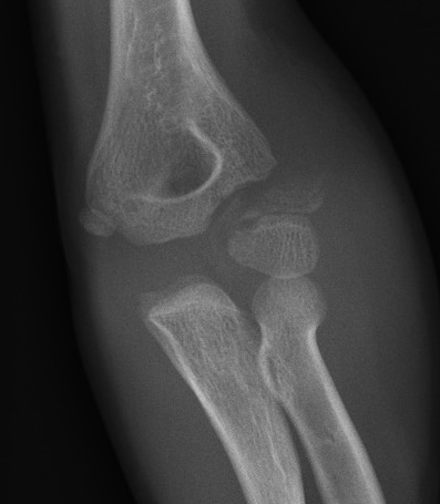 Lateral condyle