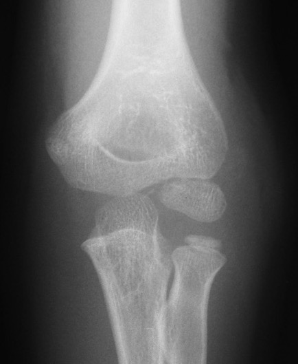 Mildly displaced lateral condyle