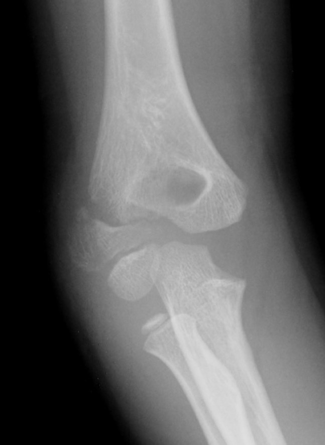 Lateral condyle