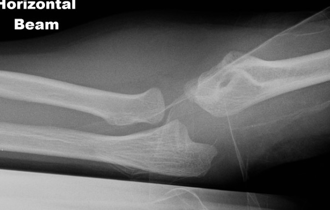 Latera condyle elbow dislocation