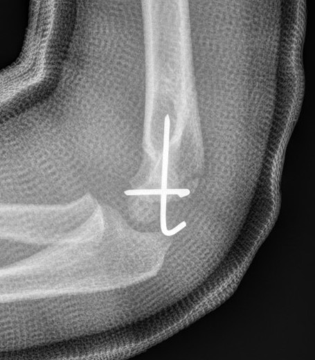Lateral condyle ORIF 2