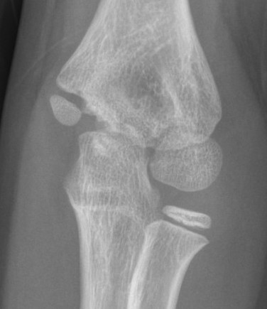 Lateral condyle overgrowth
