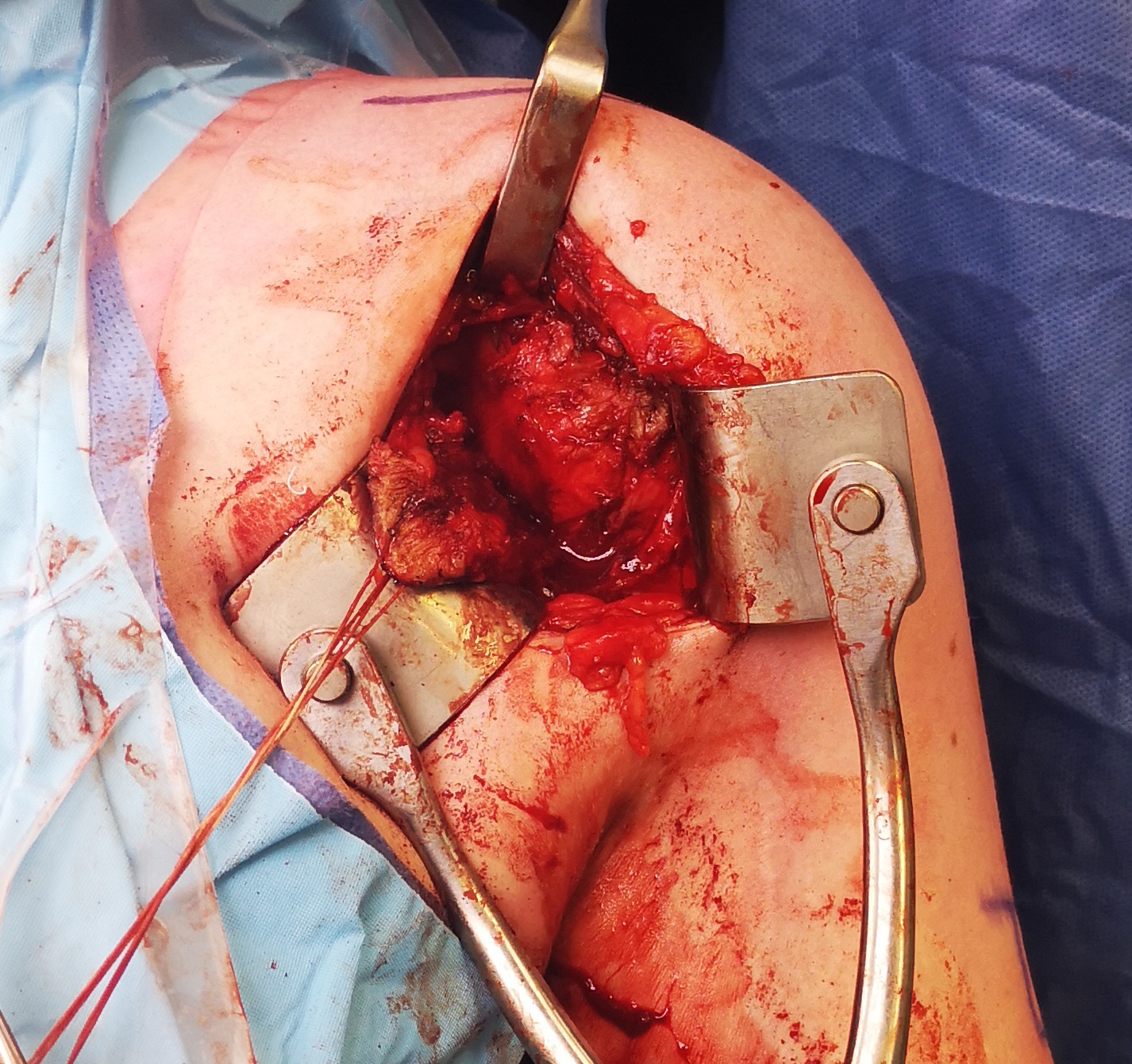 open shoulder plication