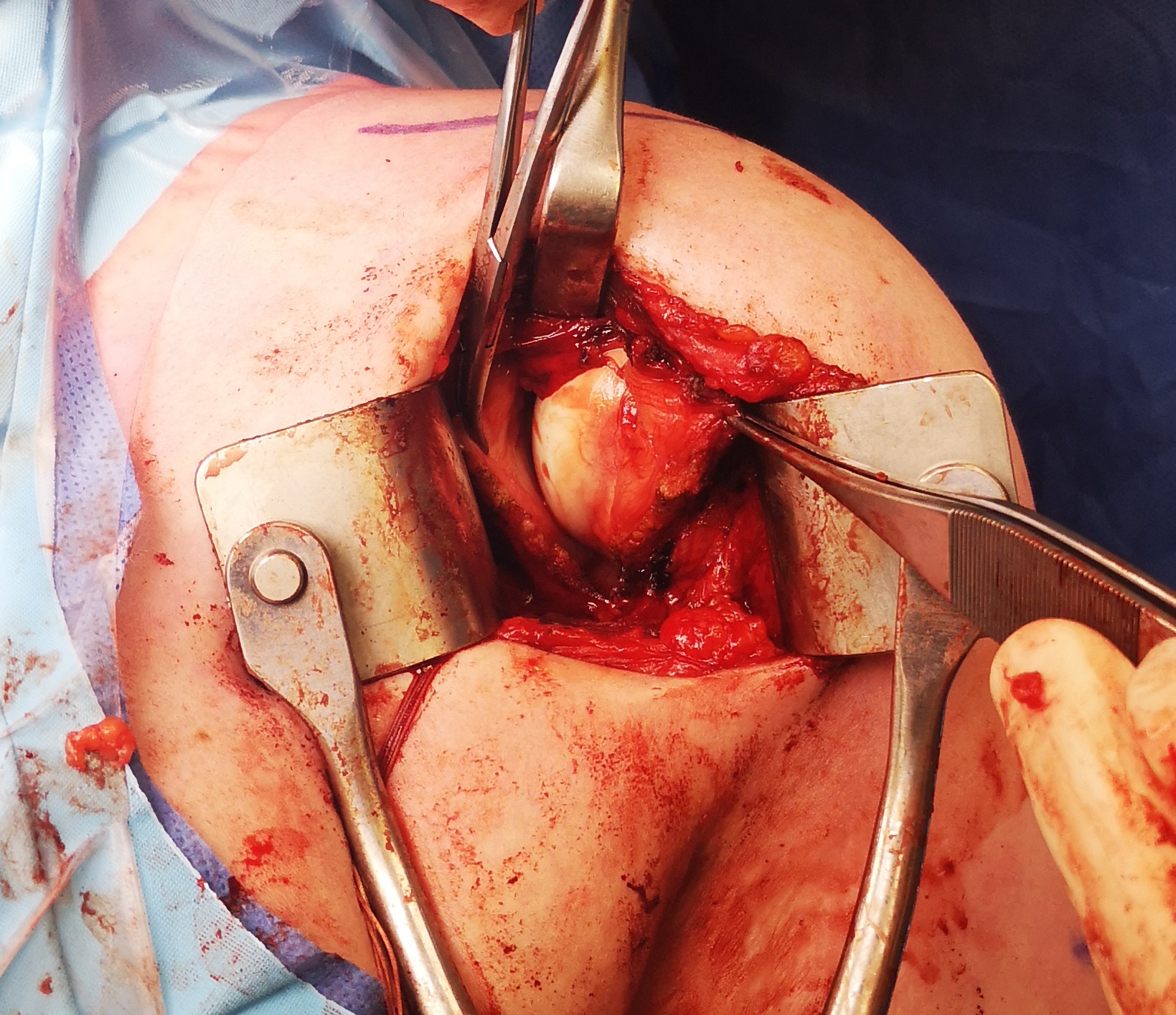 open shoulder plication