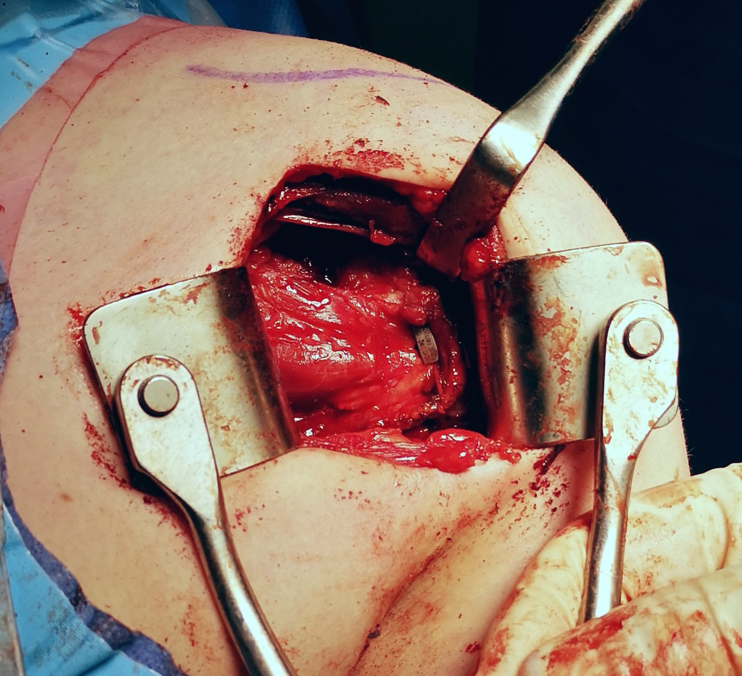 Open capsular plication