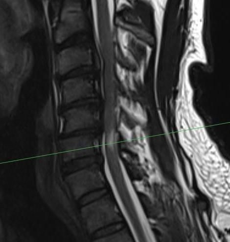 MRI central cord syndrome 1