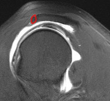 Os Acromiale MRI T2