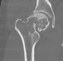 Hip Fracture CS CT 