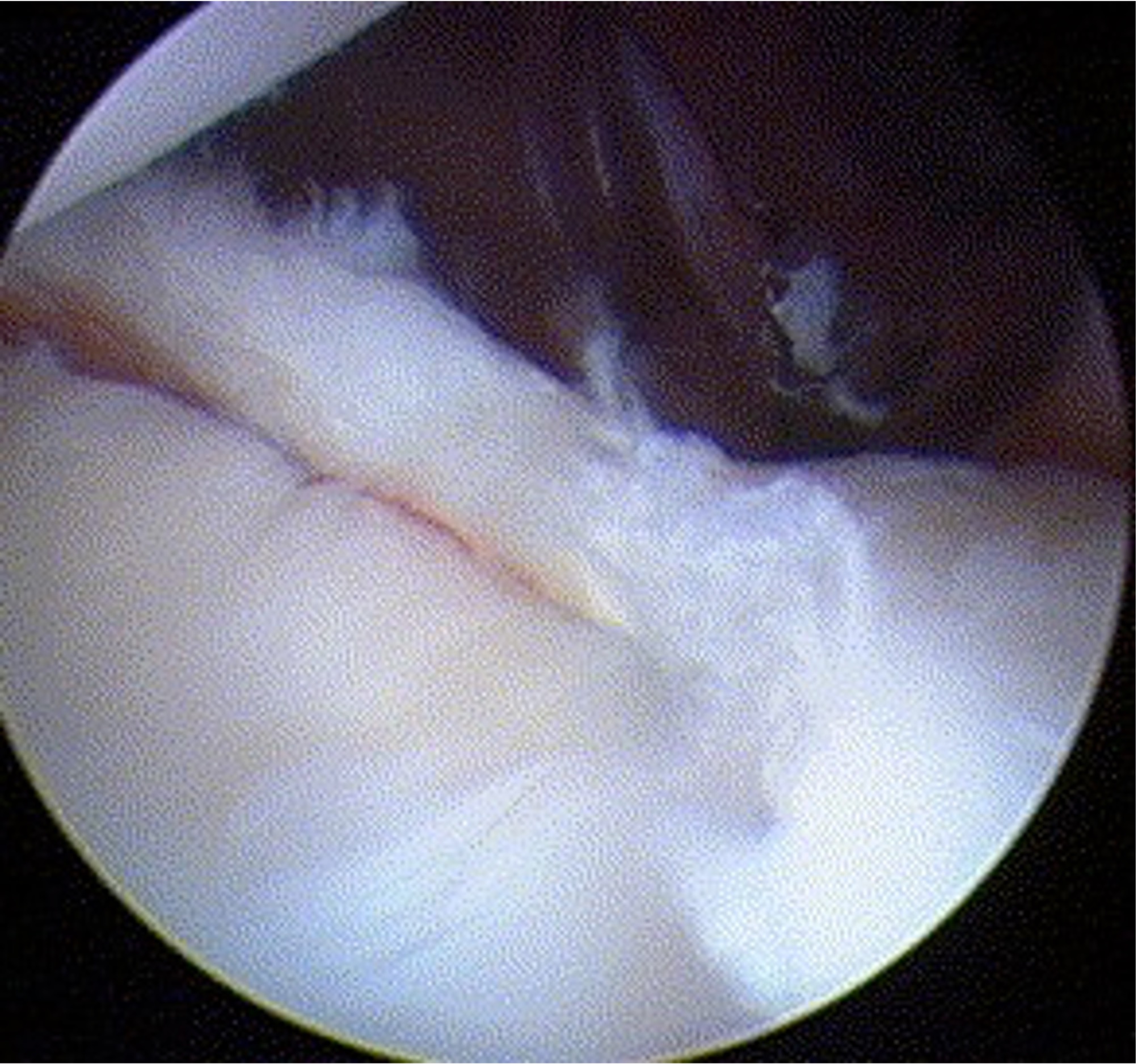 posterior labrum