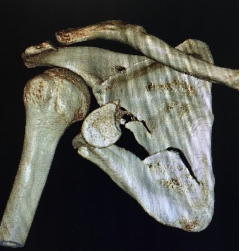 Scapula fracture