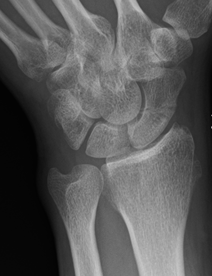 scaphoid union