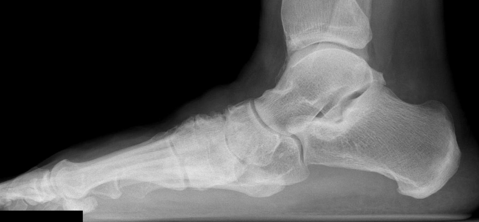 Midfoot OA