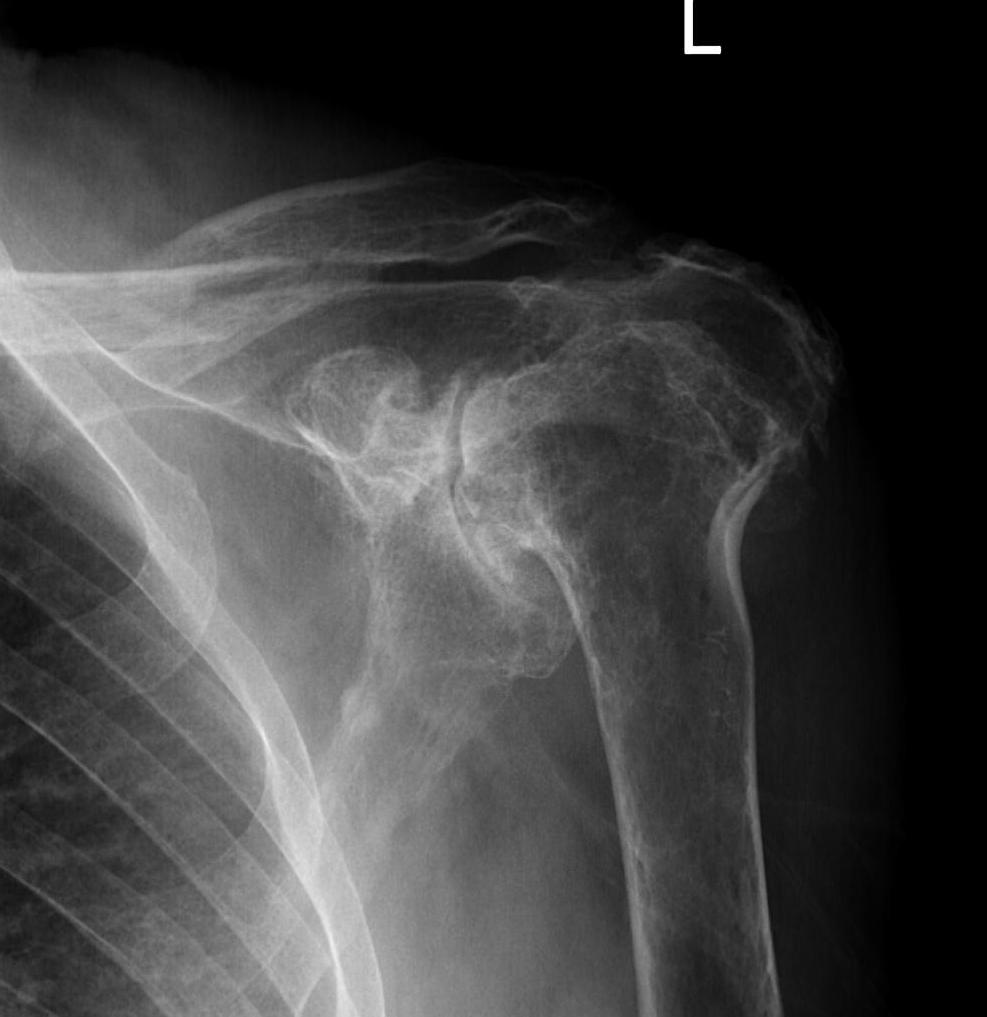 Destruction rheumatoid shoulder