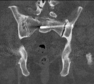 CT SI screw 2