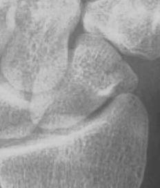 tuberosity