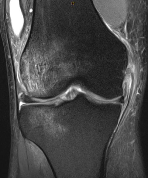 MCL acute femoral avulsion
