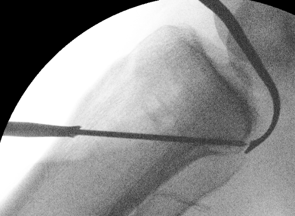 PCL tibial tunnel