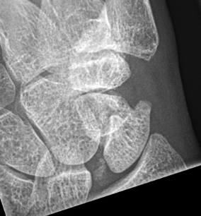 scaphoid