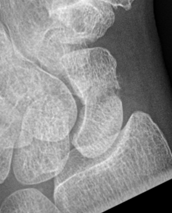 scaphoid