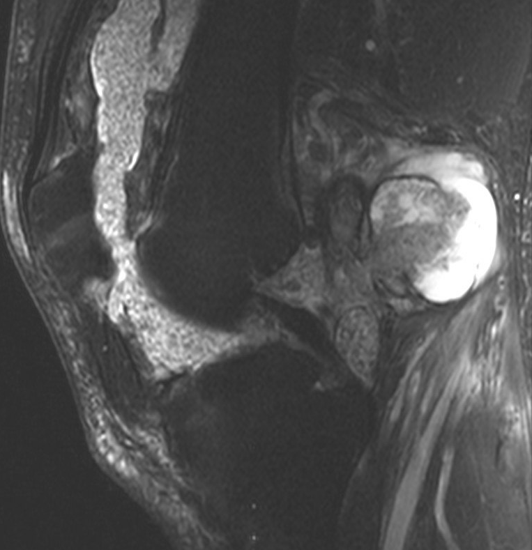 Synovial chondro knee 1