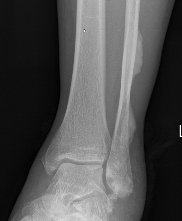 Meleorheotosis foot 1