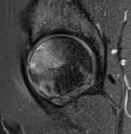 Hip subchondral fracture