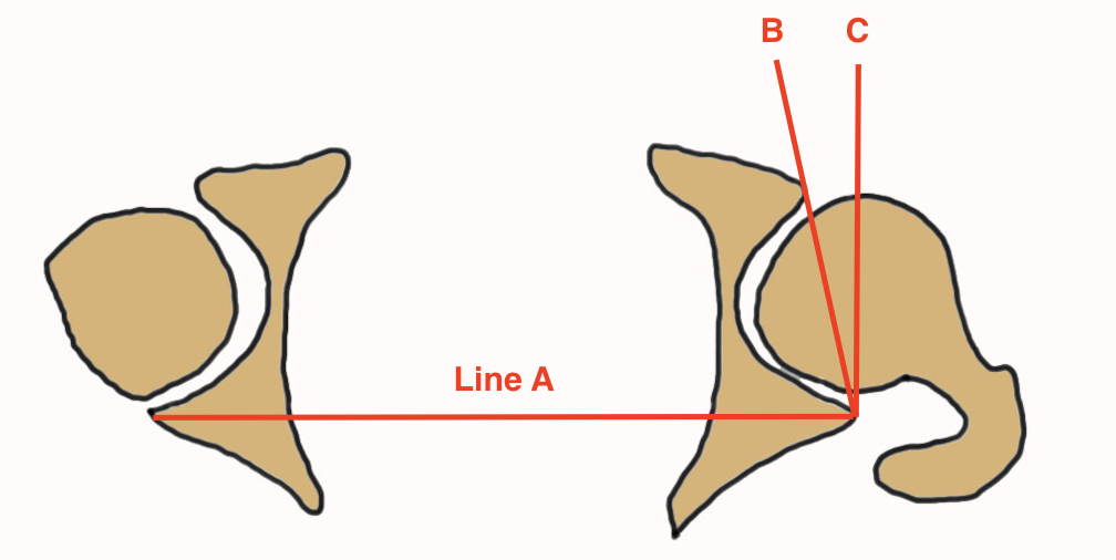 CT acetabular version