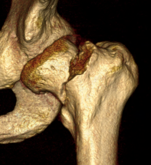 Young hip fracture