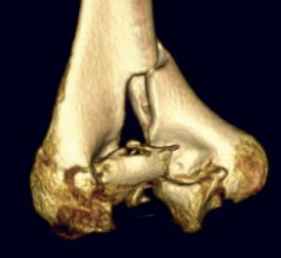 Distal humerus