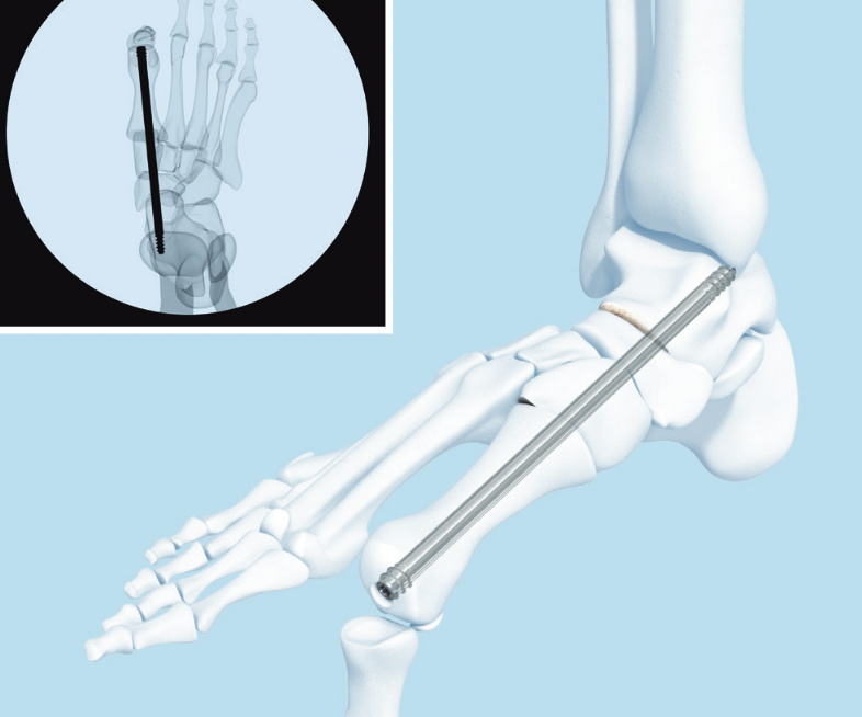 Midfoot fusion bolt