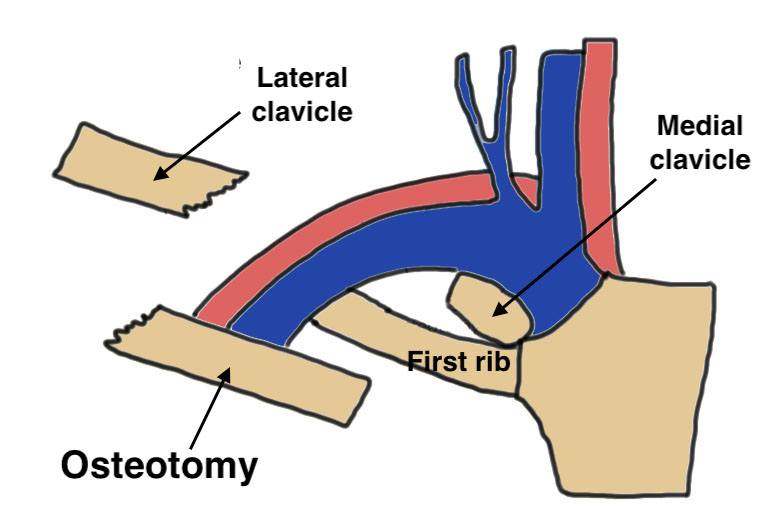 Clavicle osteotomy