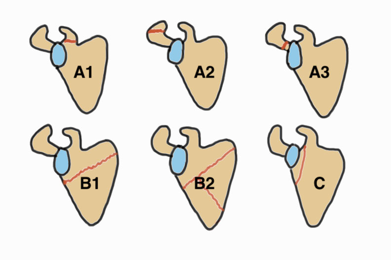 Scapula fractures