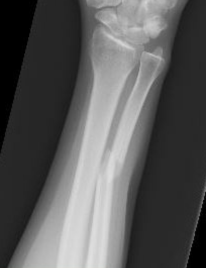 ulna