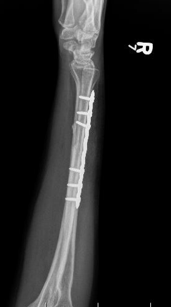 ulna
