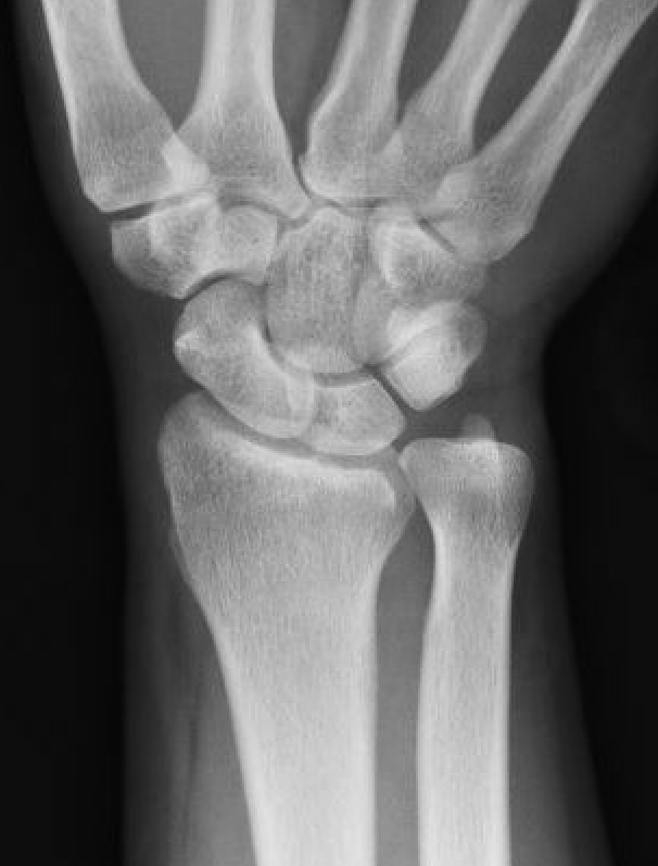 ulna