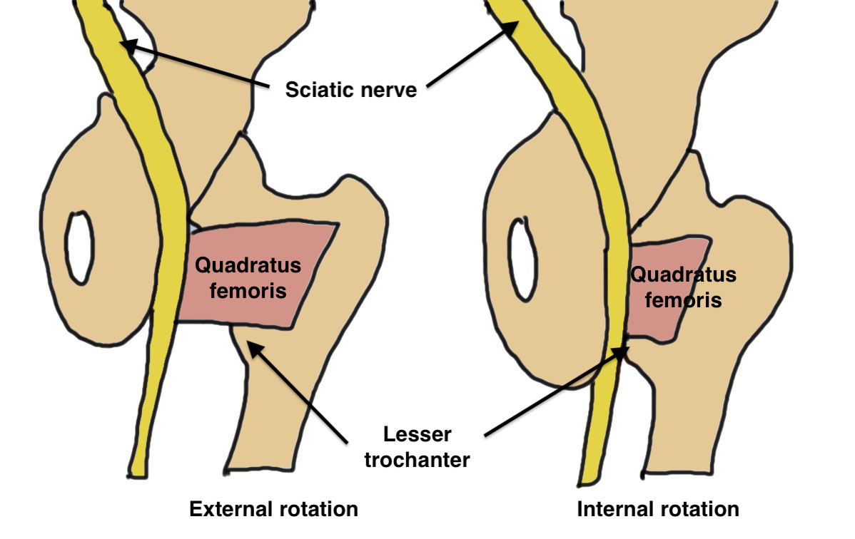 Ischiofemoral impingement