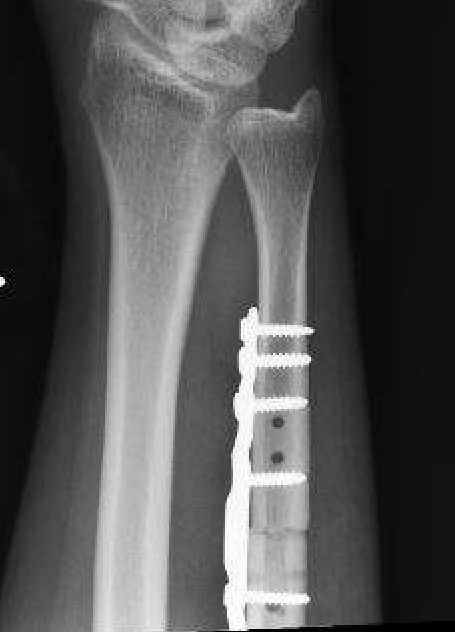 ulna shortening