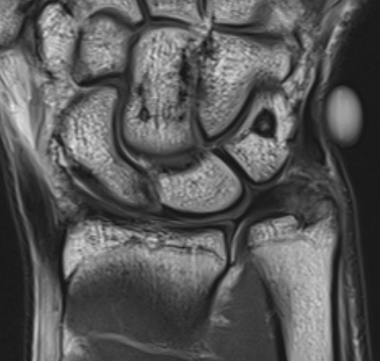ulna styloid MRI