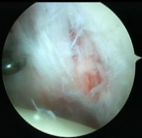 sublabral