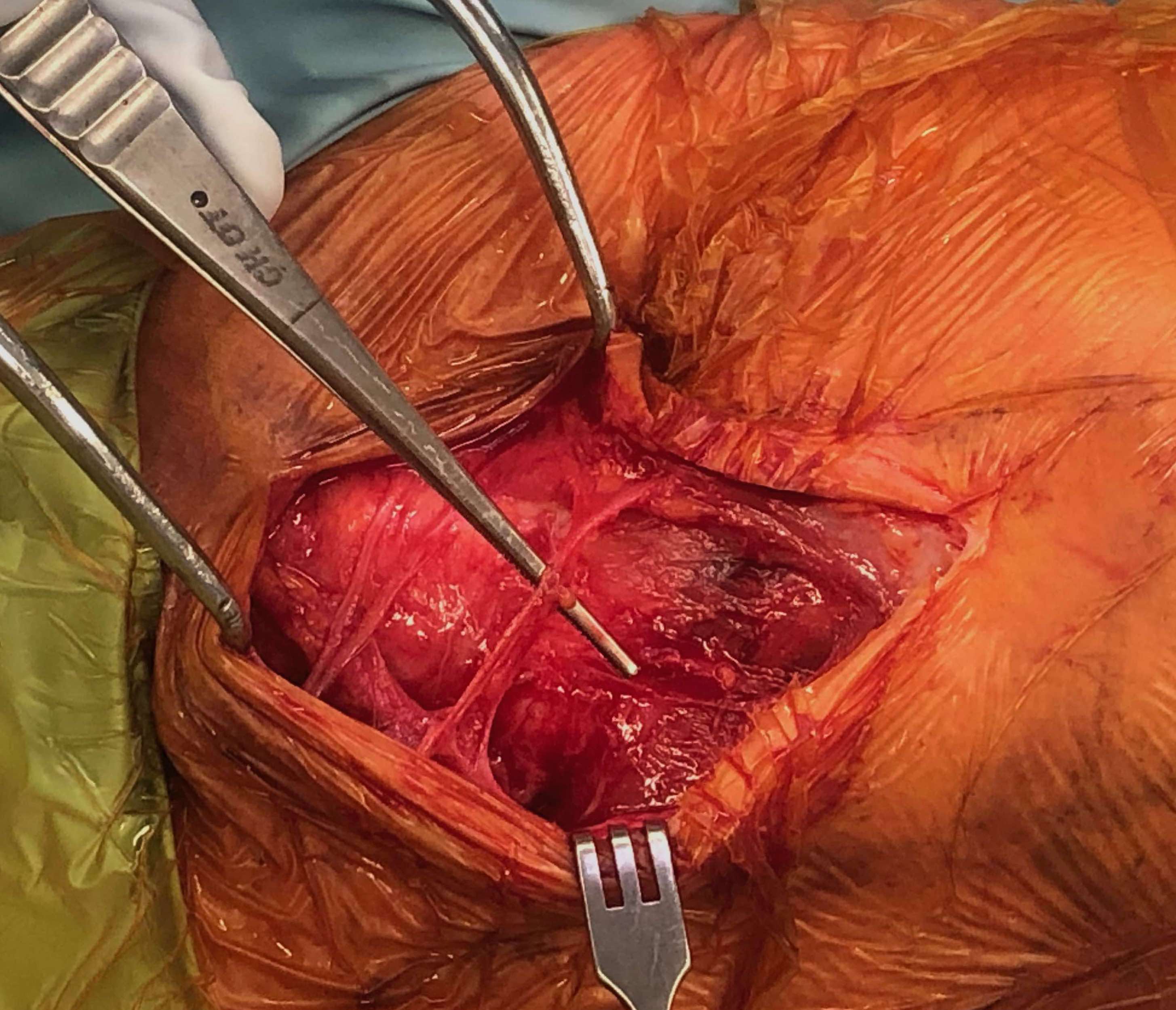 supraclavicular nerves